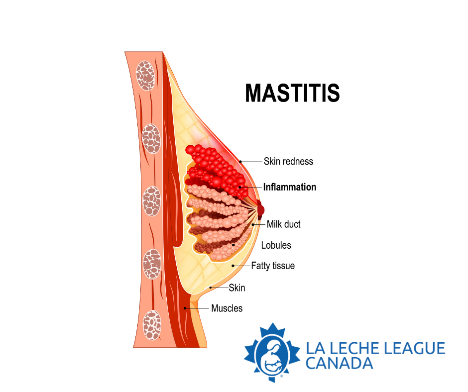 Graphic of mastitis