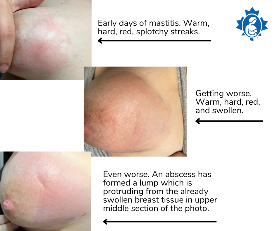 Mastitis